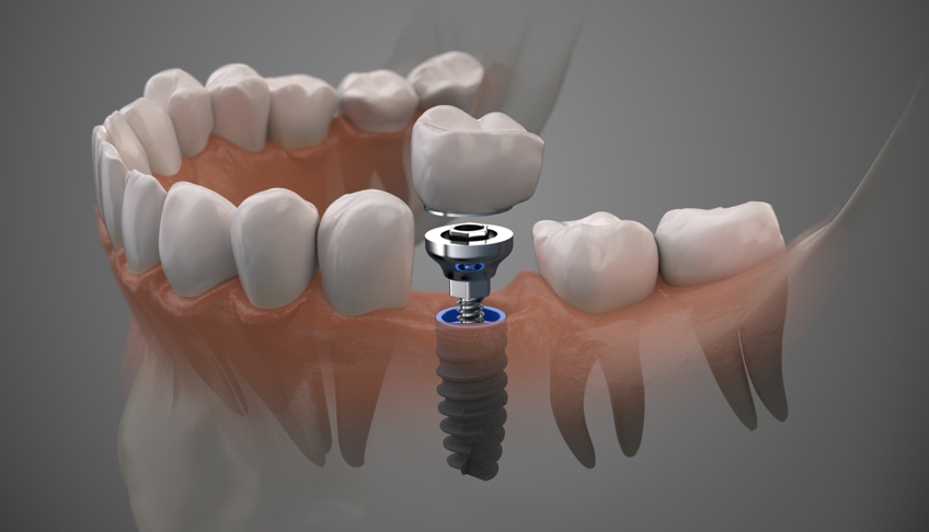 Dental implant single implant example