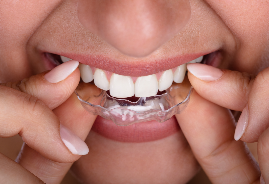 clear aligners invisalign