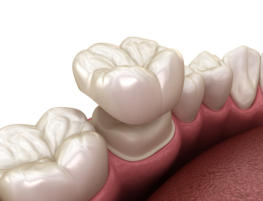 dental crowns