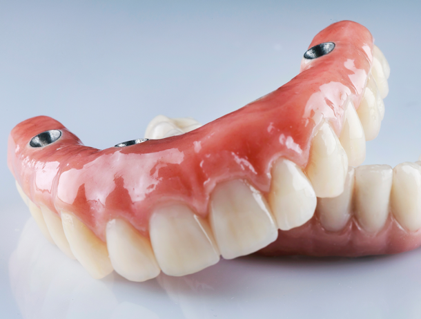 implant supported dentures