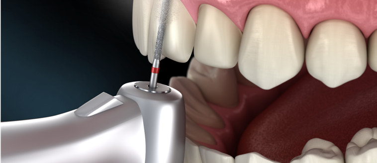 occlusal adjustments