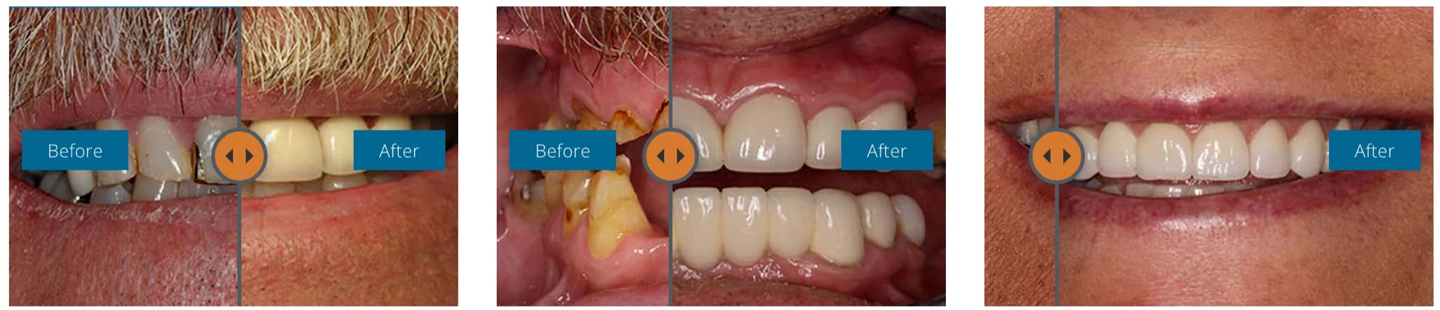 smile makeover before after