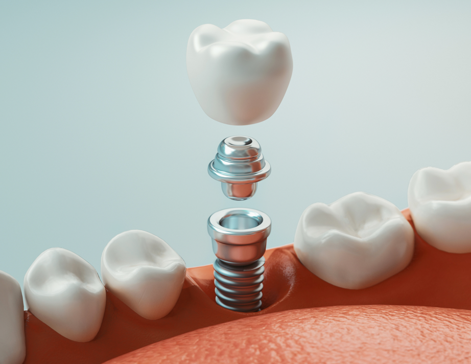 single dental implant