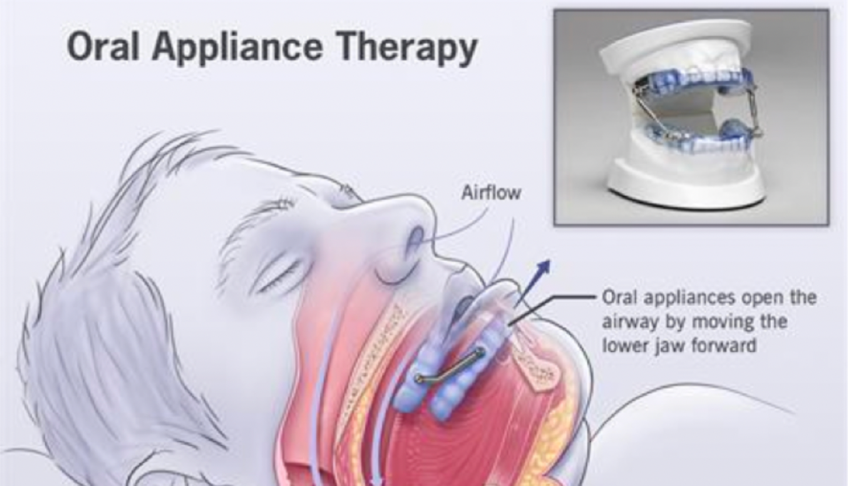 demonstrates devices used for oral appliance therapy