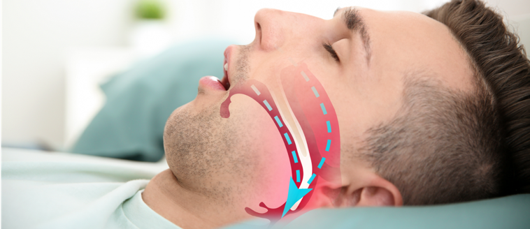 sleep apnea treatment