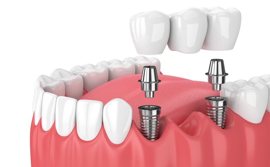 multiple dental implants