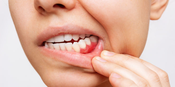 gum disease treatment